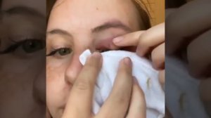 НОВОЕ ВИДЕО 2022 Прыщи давить залипательные