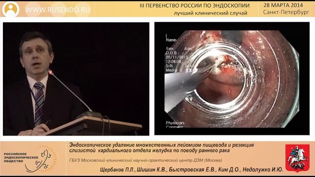Эндоскопическое удаление множественных лейомиом пищевода