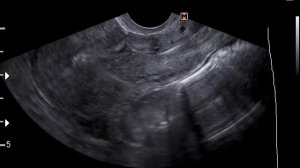 3 кесарева сечения  2 рубца на  матке,  УЗИ матки (20-3-17)