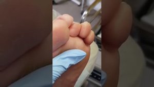 Стержневая мозоль  Обработка и удаление полой  фрезой Kleninatalia