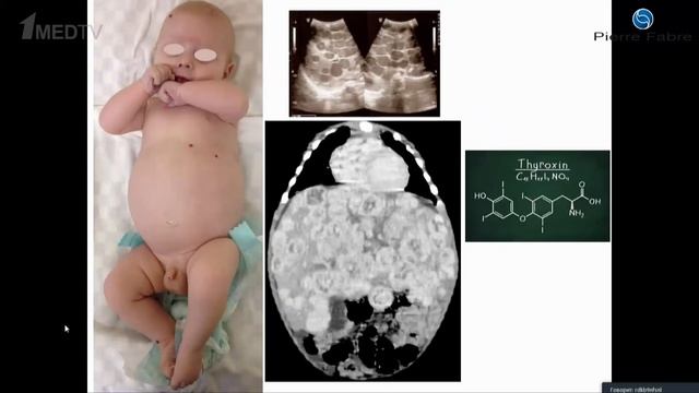 Современные проблемы в лечении инфантильной гемангиомы и пути их решения смотреть онлайн