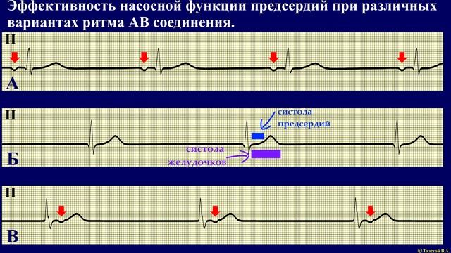 Как работает наше сердце. Часть 5. Работа сердца при различной ЧСС и аритмиях.