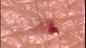 Как кусает постельный клоп.