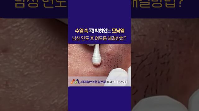 수염 근처 모낭염 해결방법