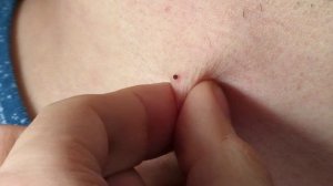 ПАПИЛЛОМЫ и БОРОДАВКИ отвалятся сами. Простой метод удаления папиллом в домашних условиях.