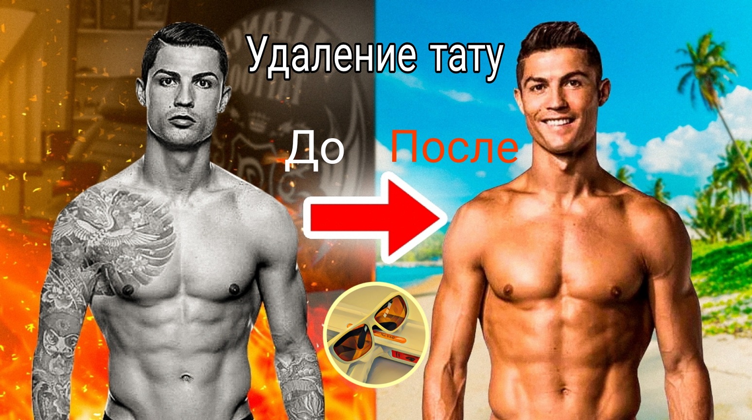 Удаление татуировки лазером от первого визита до чистой коже. Часть 1.