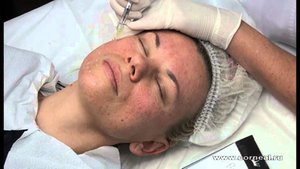 Если правильная глубина - лицо не кровит при биоревитализации