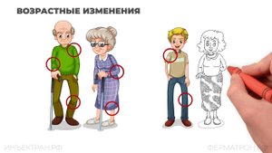 Что такое остеоартрит?