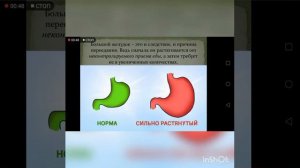 Как уменьшить объем желудка!