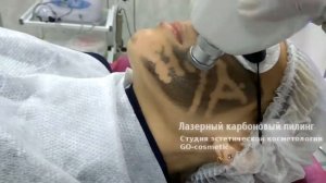 Лазерный  карбоновый пилинг, Одесса, GOcosmetic