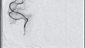 Тромбоэкстракция из артерий головного мозга