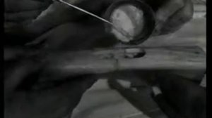 Сварка костей ультразвуком