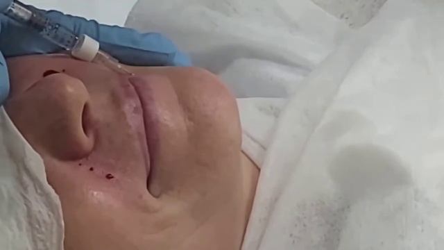 Заполнение носогубной складки филлером.