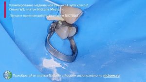Фиксация матрицы на медиальной поверхности зуба 14 клампом W2 4K