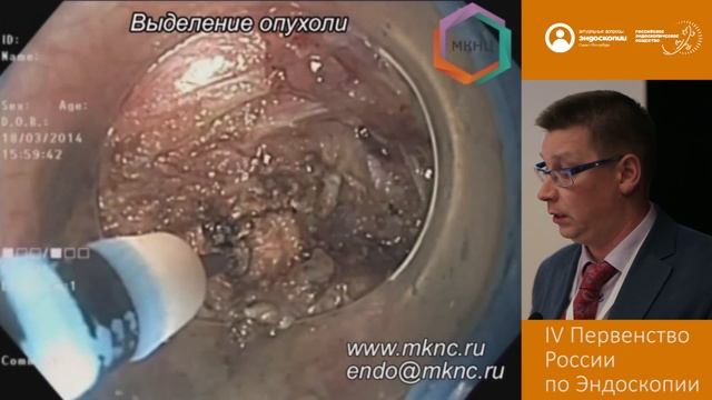 Удаление ГИСО желудка методом эндоскопической туннельной резекции
