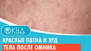 ? Красные пятна и зуд тела после омника. Клинический случай №708