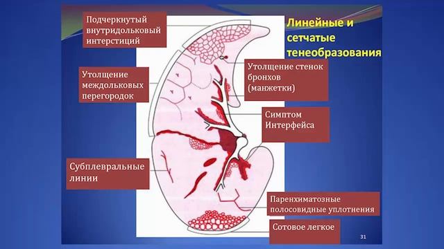 Высокоразрешающая компьютерная томография легких