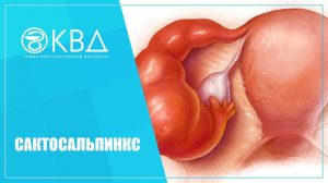? Сактосальпинкс