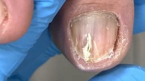 Cracks in the center of the toenails! trim nail fungus【Xue Yidao】