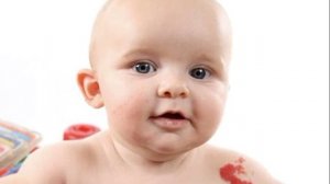 BOLALARDA GEMANGIOMA - SABABLARI, BELGILARI, DAVOLASH, OLDINI OLISH / ГЕМАНГИОМА У ДЕТЕЙ - ЛЕЧЕНИЕ