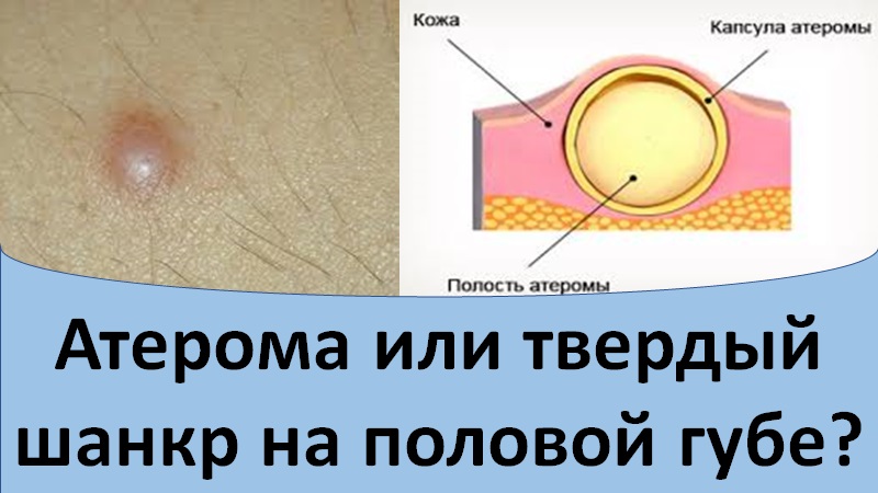 Твердый шанкр или атерома на половой губе