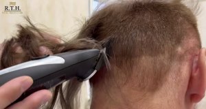 Мы не бреем зону пересадки!