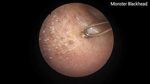 Monster Blackhead in Ear