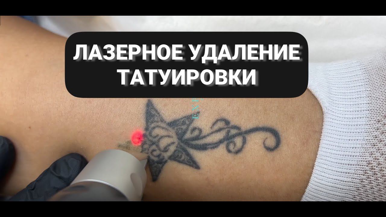 Как удалить татуировку? #удалениетатуировки