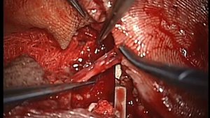 Микрохирургическая техника: шов пальцевого нерва/ Microsurgical technique: digital nerve suturing