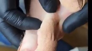 Удаление межпальцевой мозоли ?????