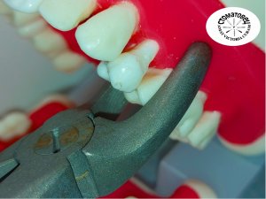 Методика удаления корня зуба, которую нельзя применять.