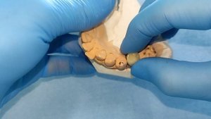 протезирование зубов