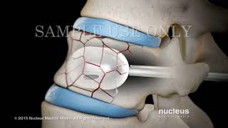 Вертебропластика , кифопластика позвоночника смотреть онлайн