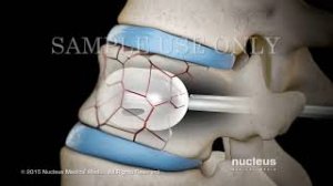 Вертебропластика , кифопластика позвоночника