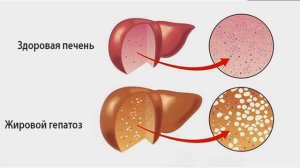 Первый механизм работы адеметионина. Борьба с гомоцистеином.