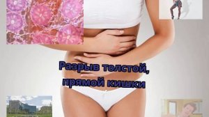 Разрыв толстой, прямой кишки