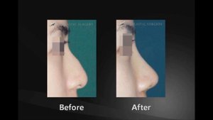 Пластическая хирургия в Корее ~ До и после ~ Plastic Surgery in Korea ~ Before and After