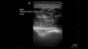 Elbow Ultrasound: Pyomyositis of Distal Triceps