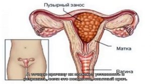 Могут ли начаться месячные после зачатия?