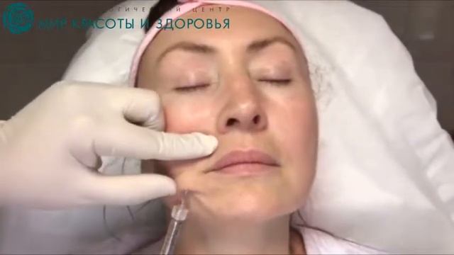 Корекция носогубных складок филлерами в Мир Красоты и Здоровья