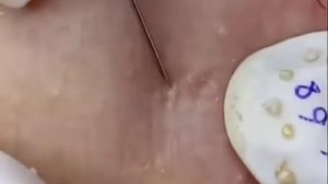Disgusting acne / acne treatment / pimple popping / blackheads/  черные точки / давить прыщи