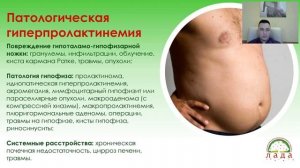 Кузнецов Дмитрий Алексеевич. Гиперпролактинемия у мужчин.