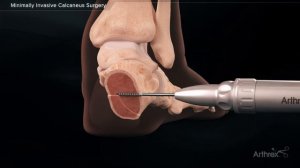 Minimally Invasive Calcaneus Surgery