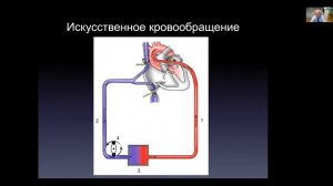 Искусственное кровообращение. Кардиохирургия для кардиологов. БМ-2. Профессор Шихвердиев Н.Н.