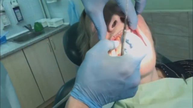 Пациентка Б Полное протезирование Дневник врача-стоматолога Какшинского В Д 4-я стоматология смотреть онлайн