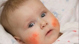 ВЫСЫПАНИЯ НА ДЕТСКОЙ КОЖЕ | Разбираемся в детской сыпи