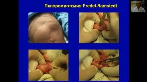Врожденная кишечная непроходимость у детей