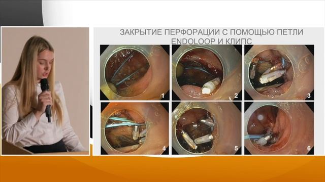 1 Лазарева АС, Вербовский АН, Вакурова ЕС Эндоскопическое лечение перфорации нисходящей ветви 12пк смотреть онлайн