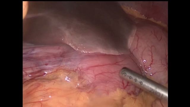 Диагностическая лапароскопия. Смывы смотреть онлайн