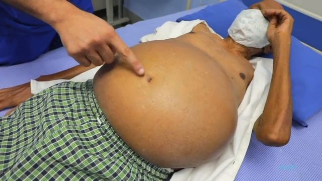 Clinical Examination of Cirrhotic Liver Disease - Final Year MBBS Practical Case смотреть онлайн